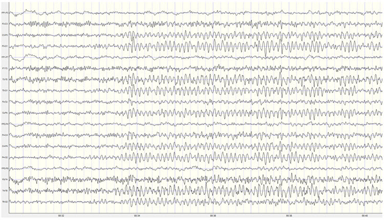 Second recording eyes-open to eyes-closed transition showing clear alpha response
